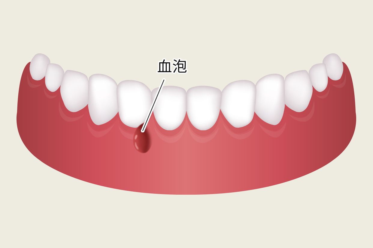 牙床长了血泡怎么办图片