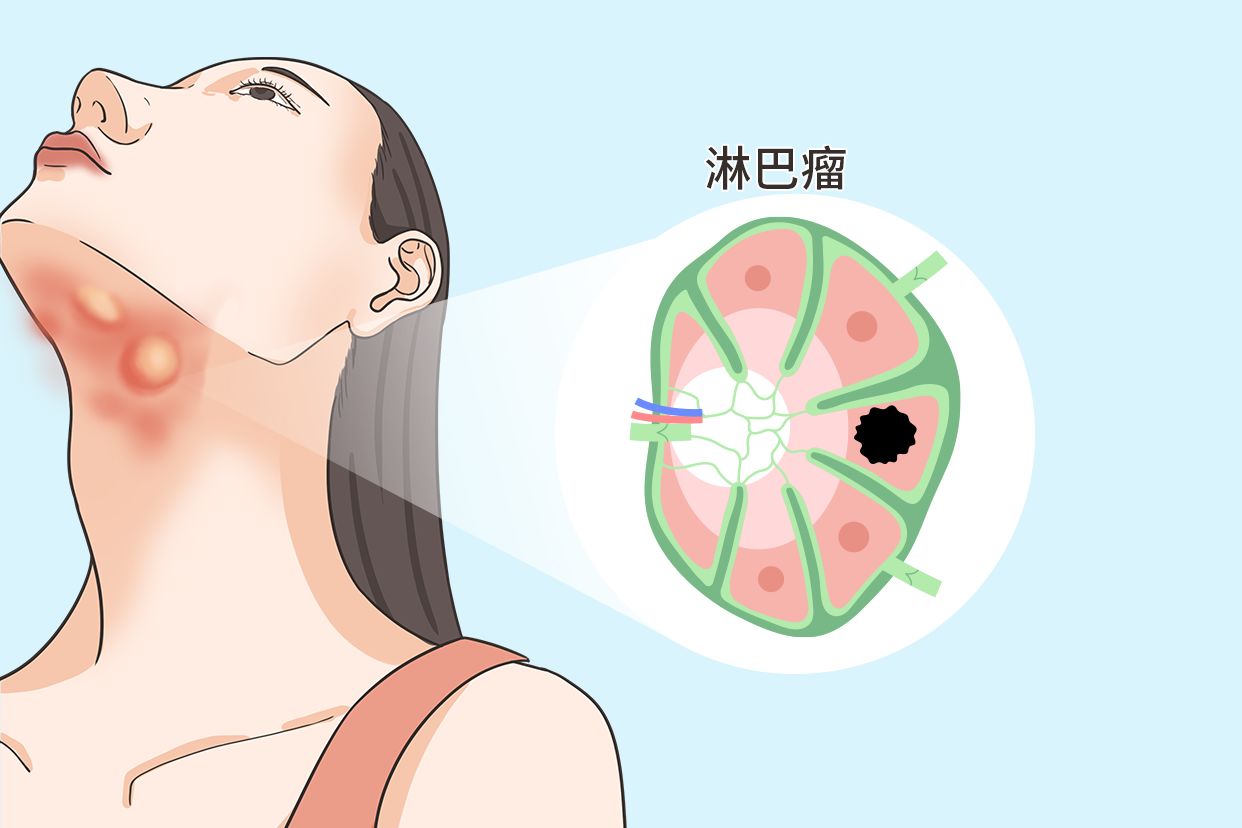 颌下淋巴瘤的图片 下颌淋巴肿瘤的图片