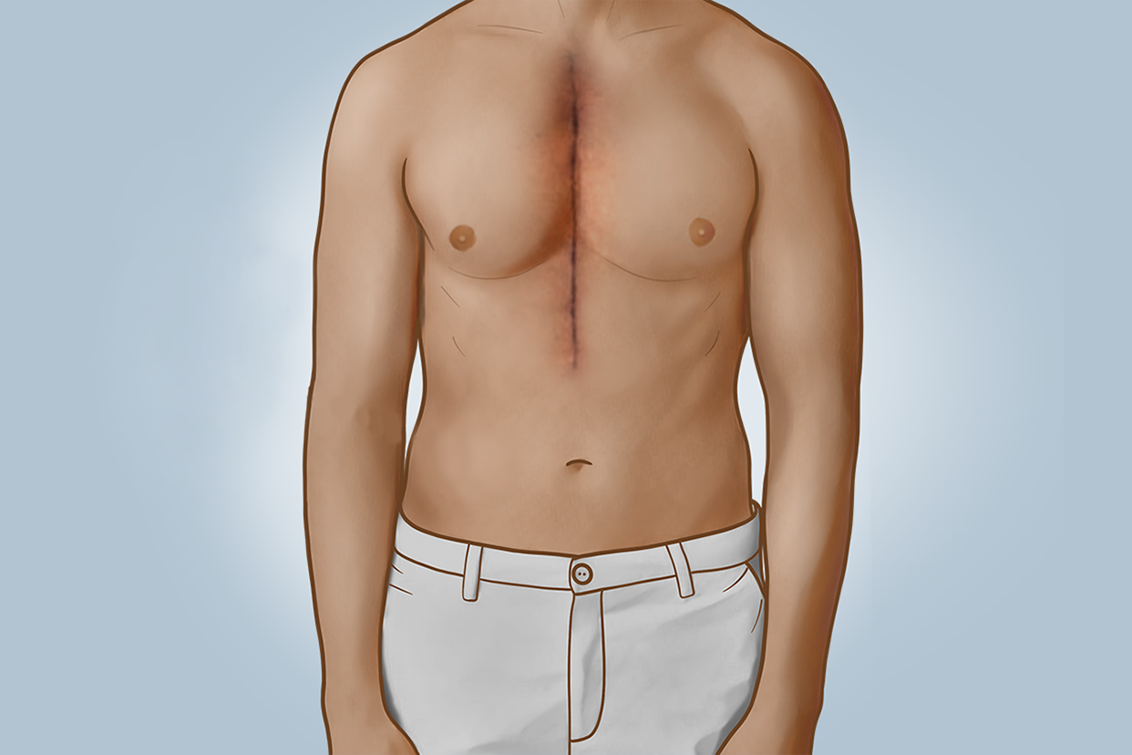 开胸手术拆线后伤口图片 开胸手术后拆线过程