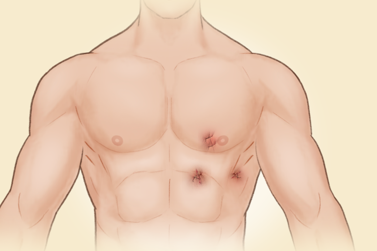 心包囊肿微创手术后伤疤图片（心包囊肿微创手术后伤疤图片）