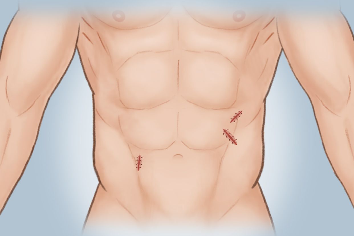 腹部补片手术后图片 腹部有补片还能做腹部手术吗
