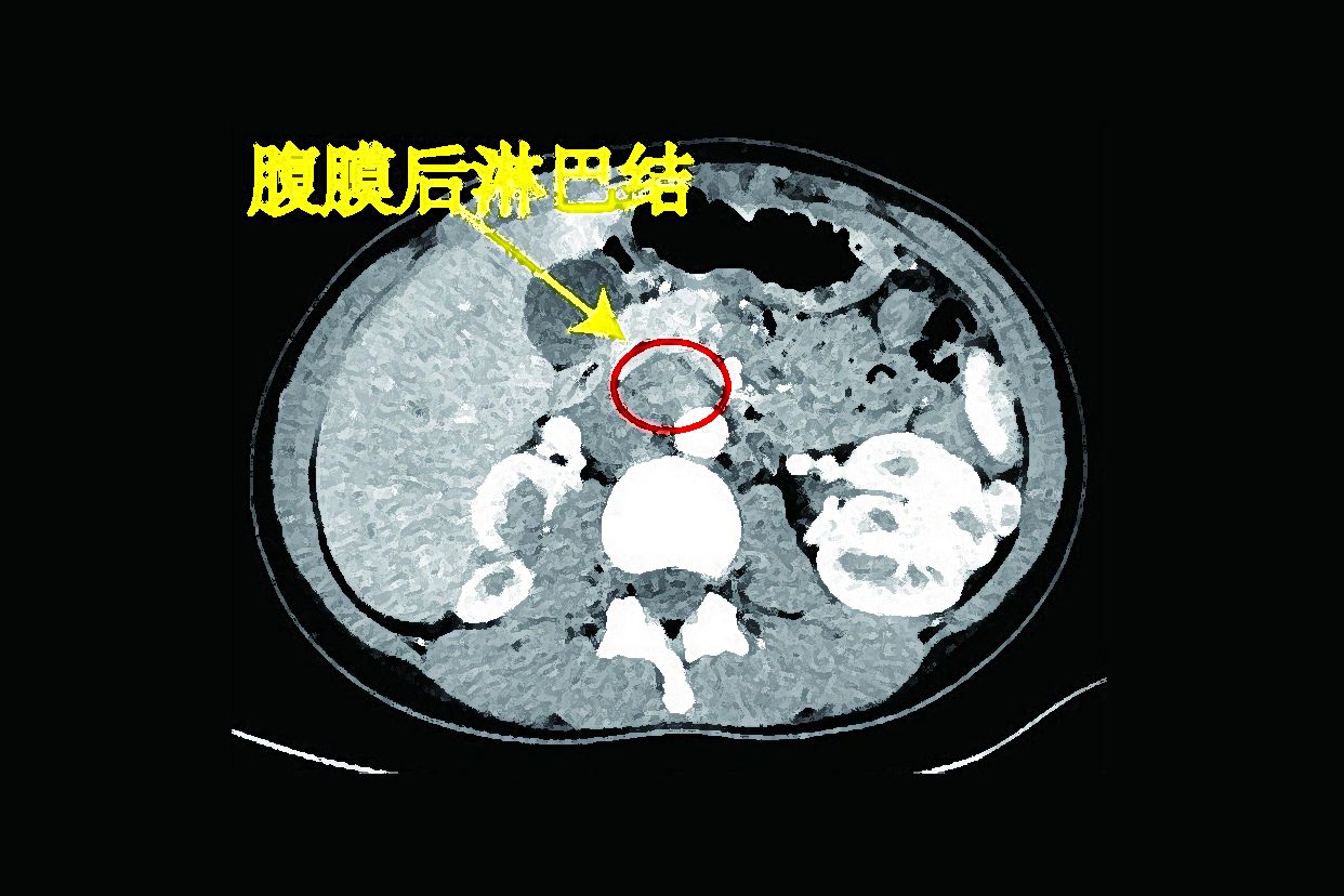 腹膜后淋巴结ct图像（腹膜后淋巴结ct图像怎么看）