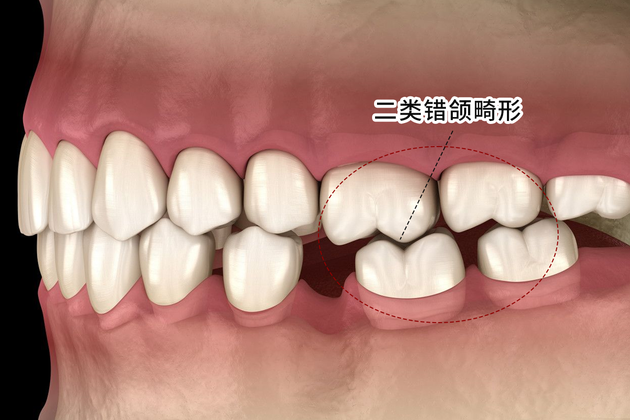 二类错颌畸形图片 二类错颌畸形