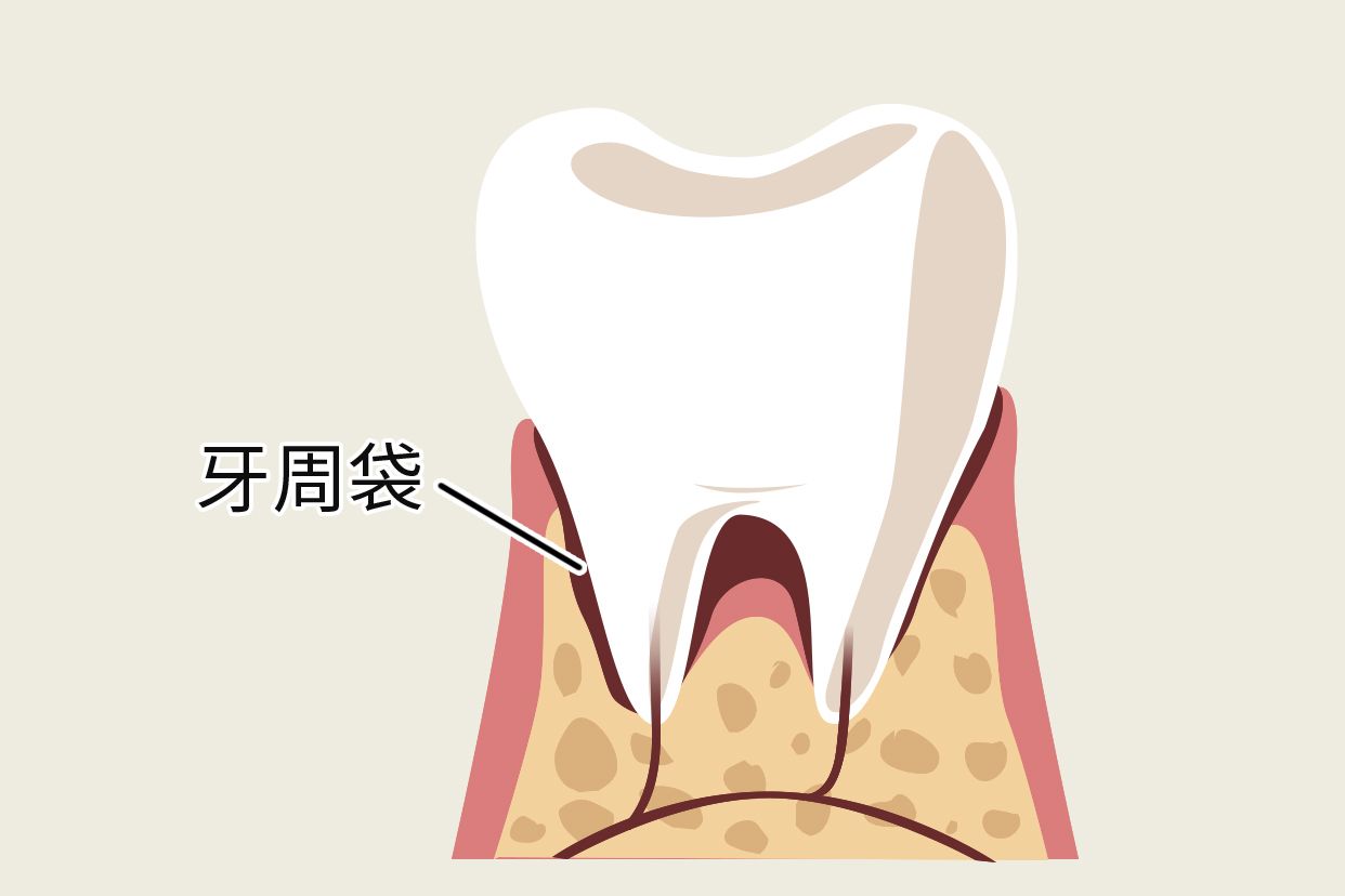 什么是牙周袋及图片 牙周袋长什么样子图片