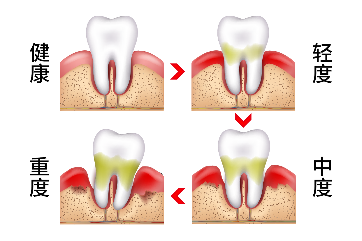 牙周轻中重度前后图片 牙周轻中重度分类图片