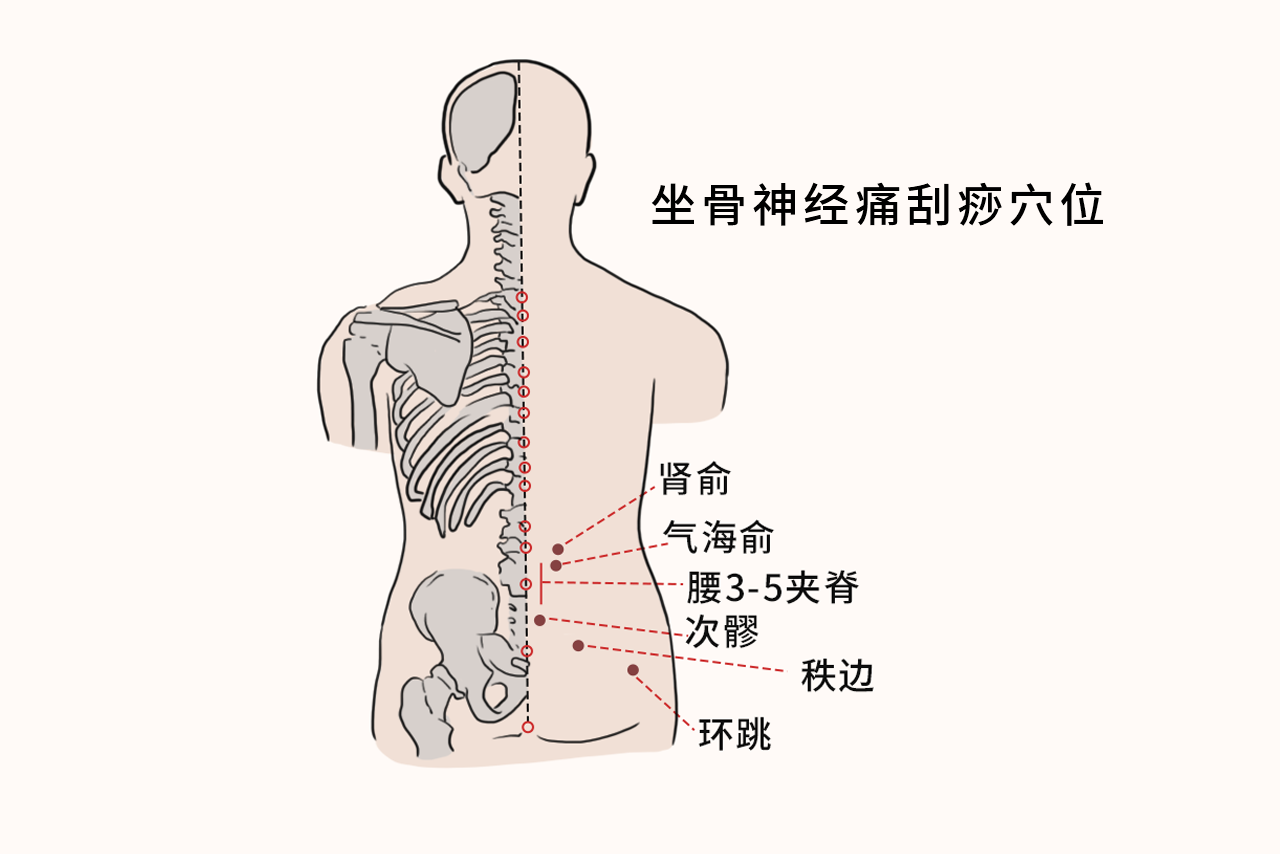 坐骨神经刮痧的方法示意图（坐骨神经痛刮痧经络图）