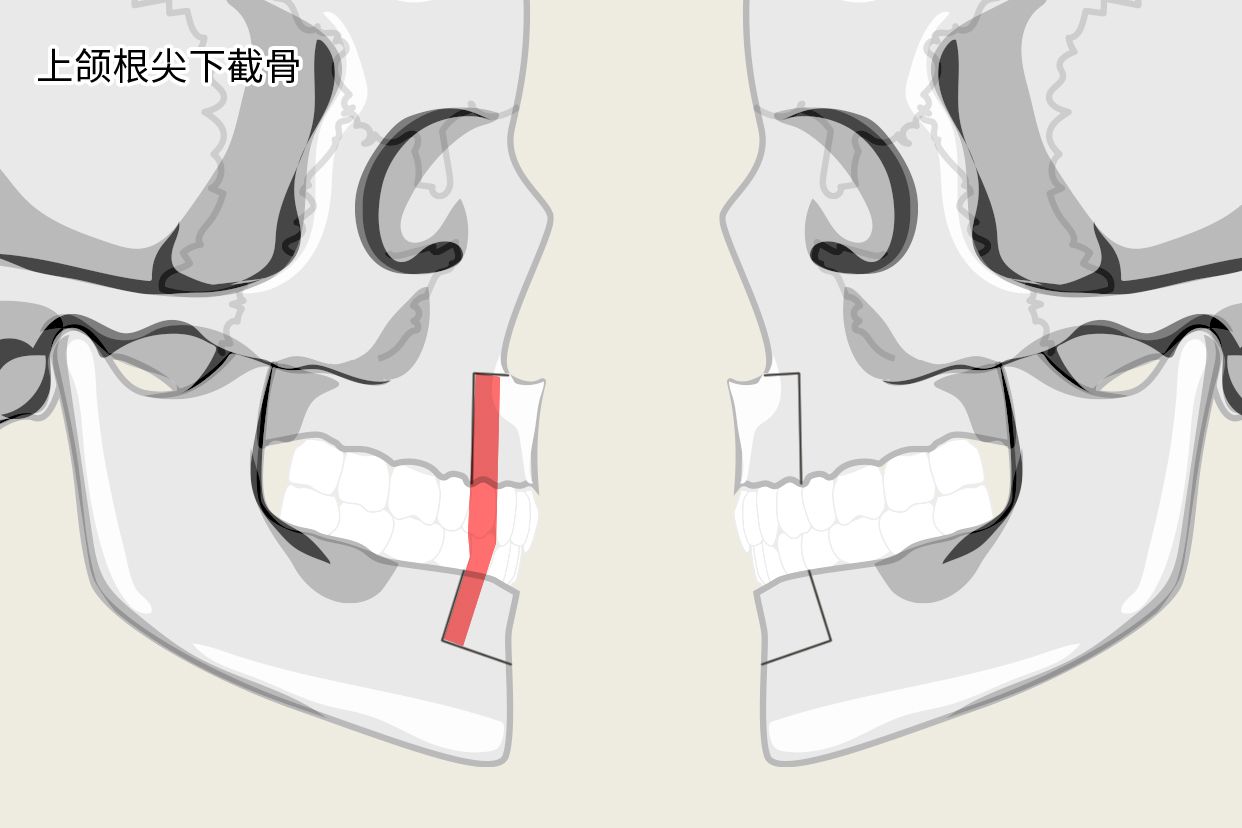 上颌根尖下截骨示意图 下颌骨根尖下截骨术