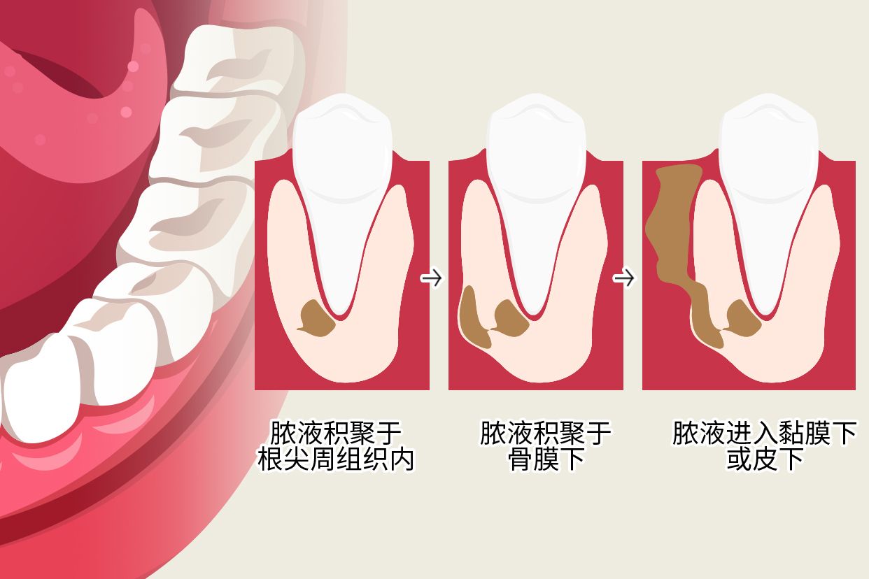 根尖周炎图片全景牙图（根尖炎图片 牙片）