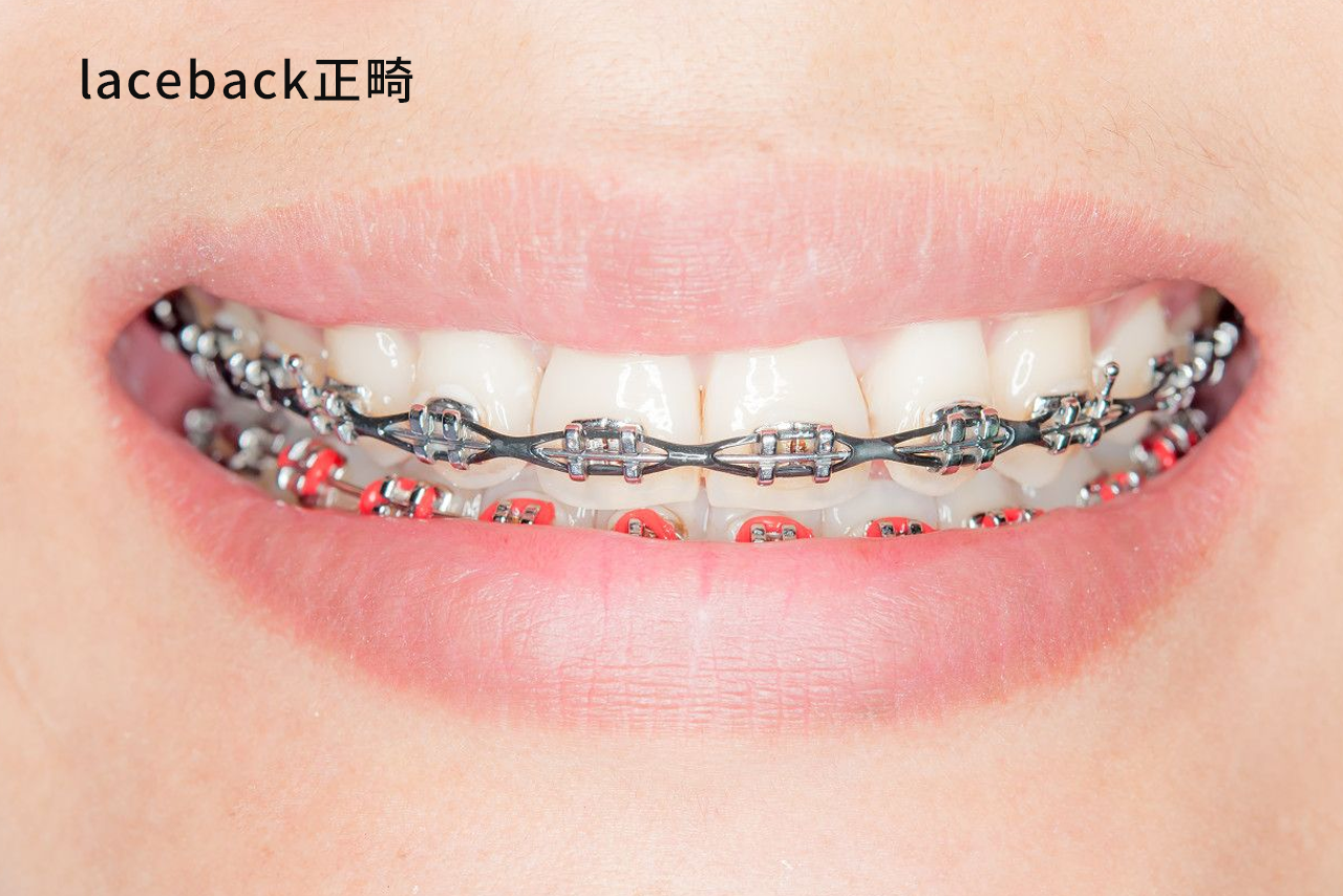 laceback正畸示范图（正畸laceback图片）