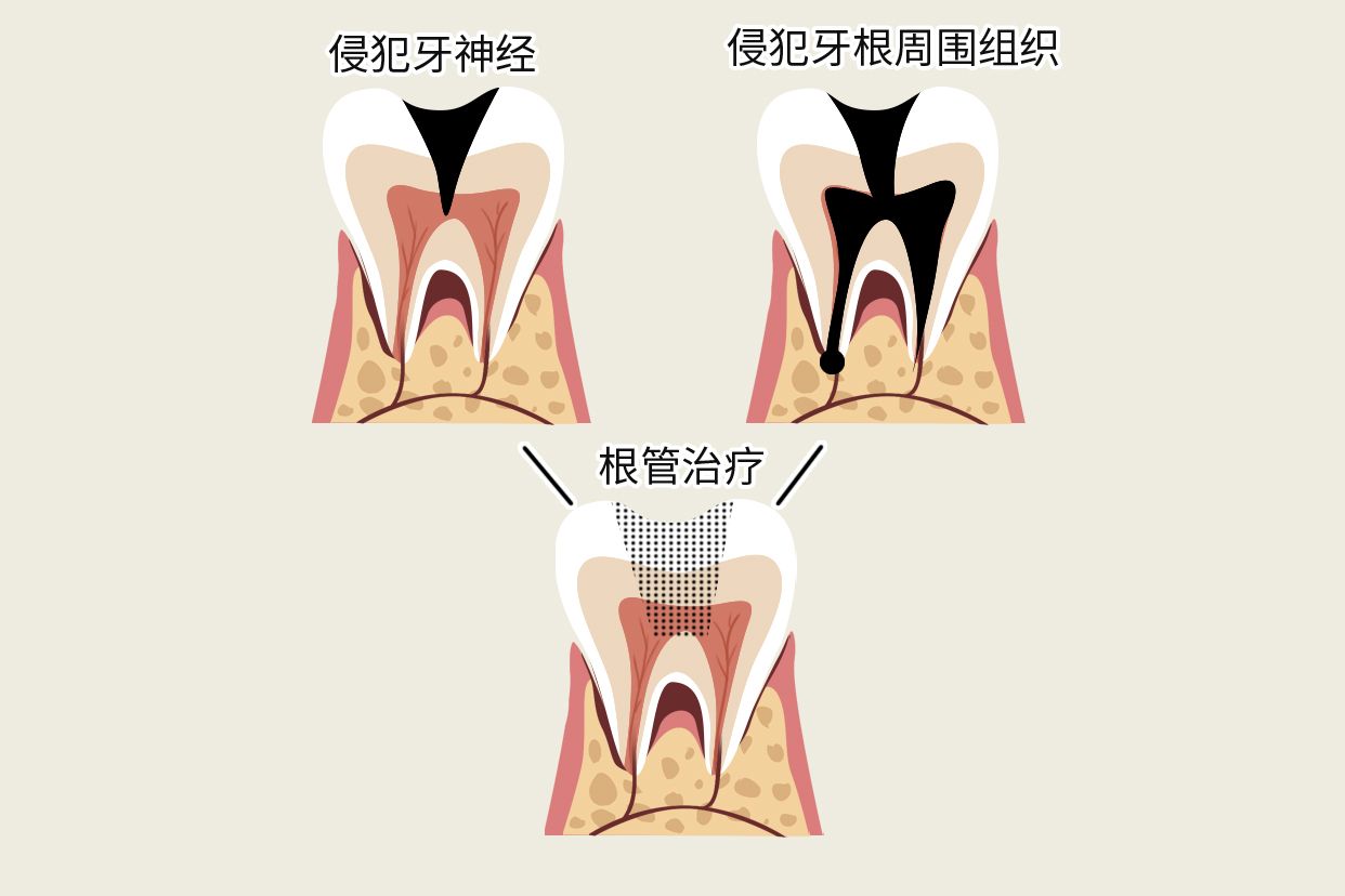 牙烂到什么程度要根管治疗图片（牙齿烂成什么样需要根管）