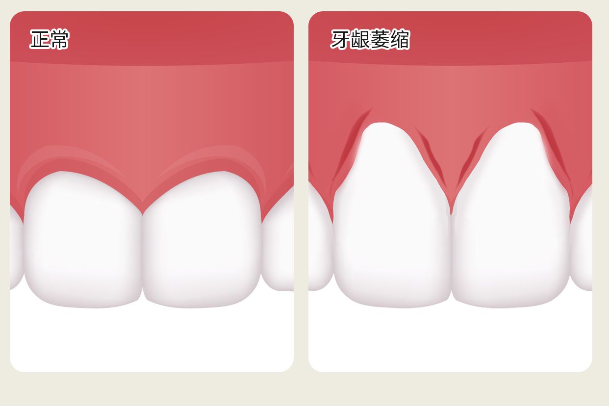 正常没萎缩的牙龈图片（正常没萎缩的牙龈图片真实）