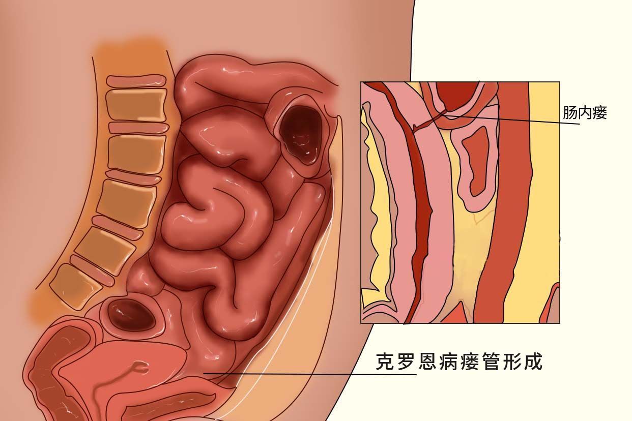 克罗恩病瘘管形成图片 克罗恩造瘘手术是什么