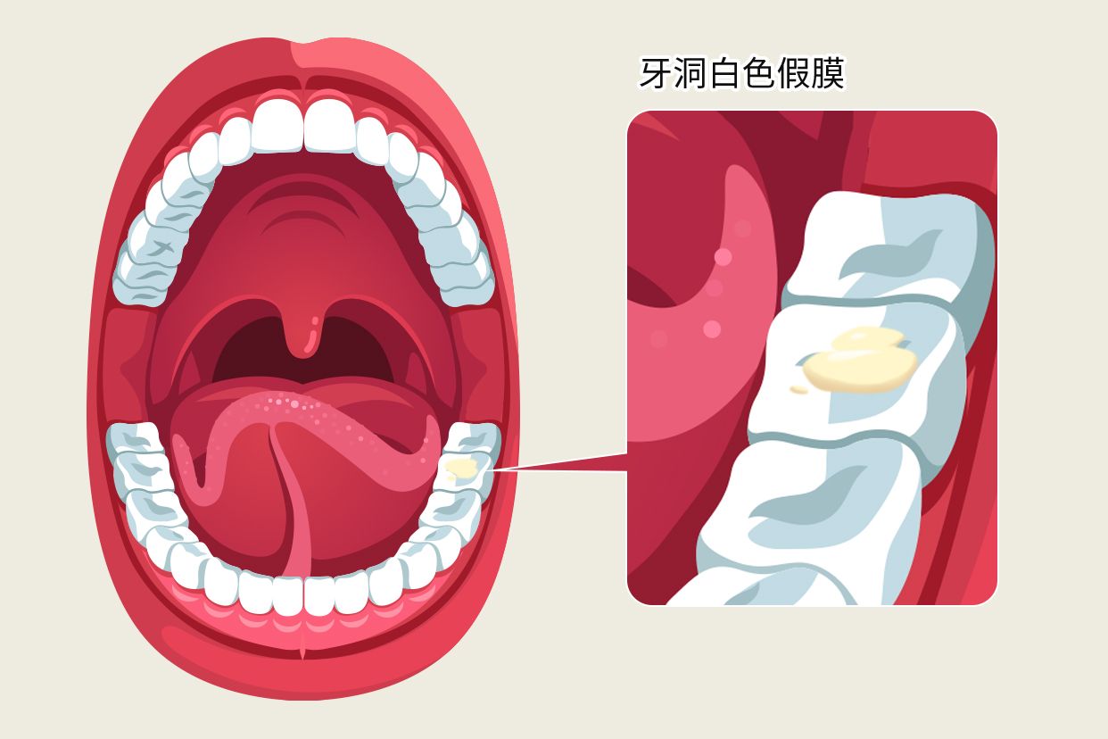 牙洞白色假膜图片（牙洞白色假膜图片高清）