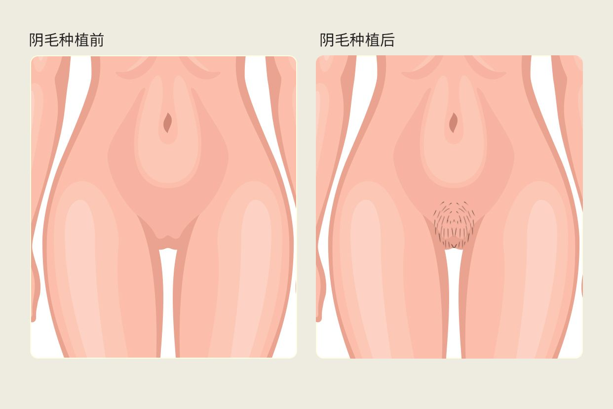 女人阴毛种植前后对比图片