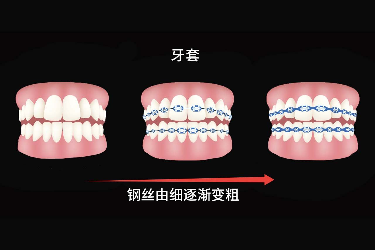 牙套换钢丝粗细顺序图片（牙套换钢丝粗细顺序图片大全）