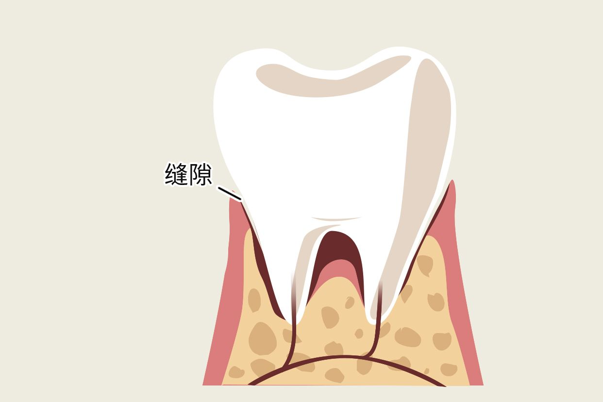 牙冠和牙龈有缝隙图 牙冠和牙龈有缝隙图解