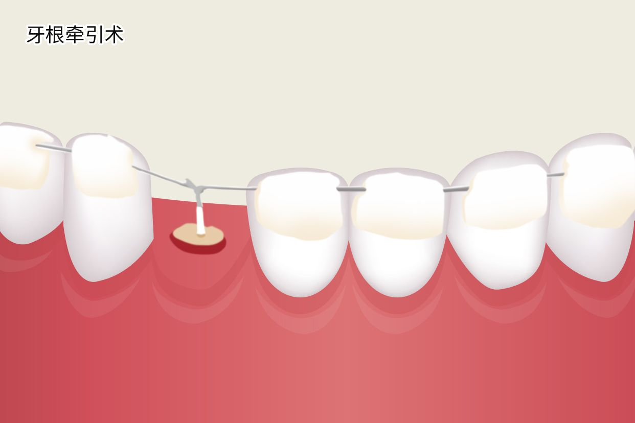 牙根牵引术图解（牙齿牵引术）