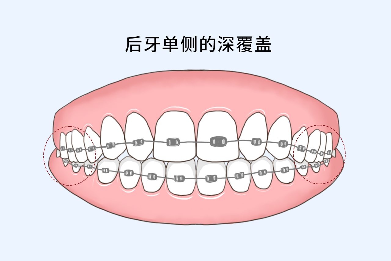 后牙单侧的深覆盖如何矫正图片 单侧后牙反合的矫正方法