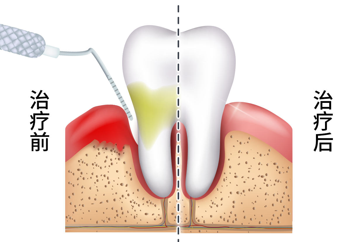 牙周炎牙缝修补效果图（牙周炎牙缝修补效果图视频）