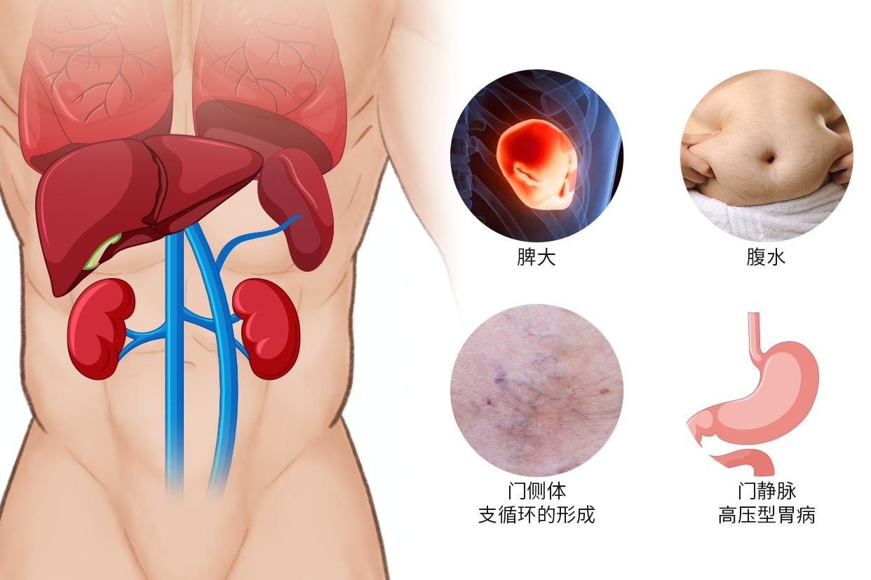 门静脉高压图片 门静脉高压图片高清