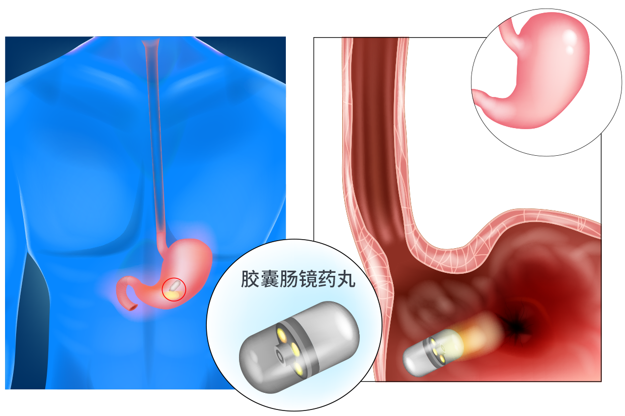 胶囊肠镜药丸图片（胶囊肠镜药丸图片真实）