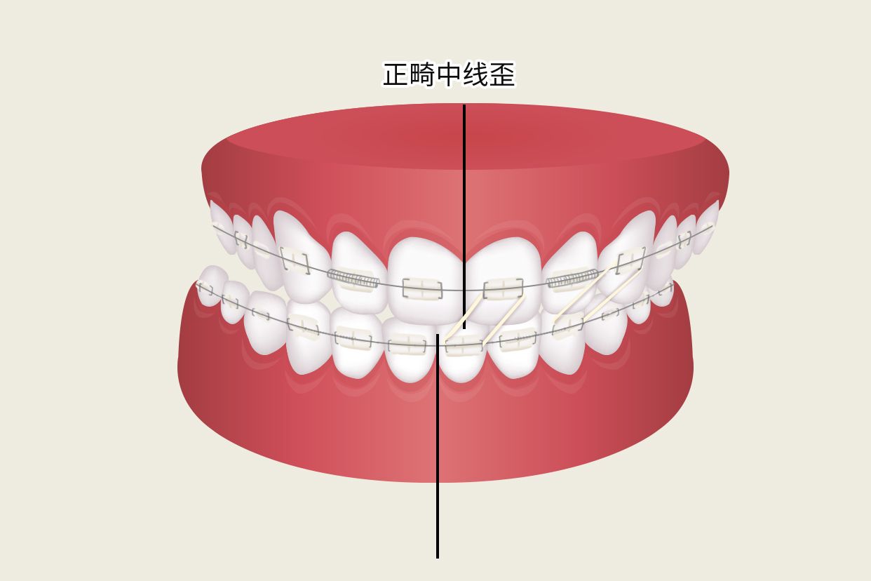 正畸中线歪如何牵引示意图（正畸垂直牵引示意图）