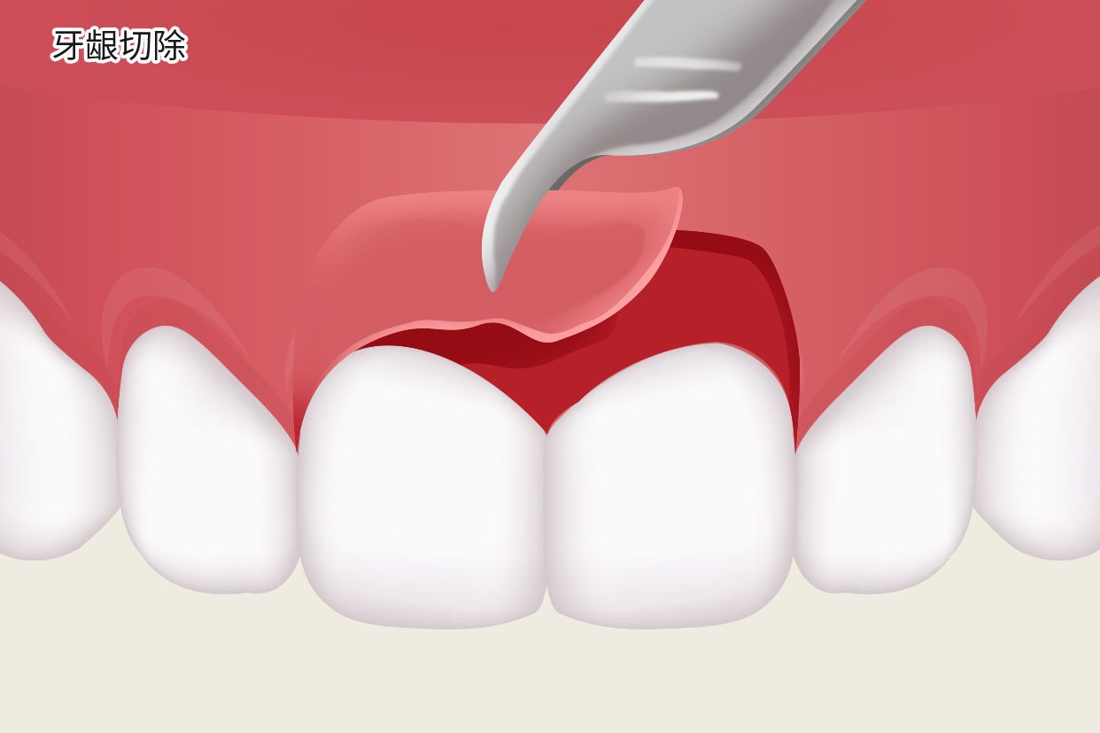 牙龈切掉能长吗图片（牙龈切多了可以长回来点吗）
