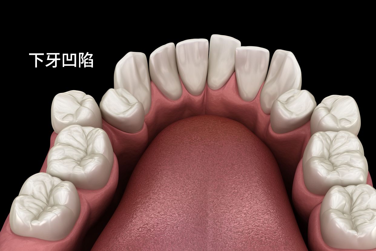 下牙凹陷图片（下牙齿凹陷）