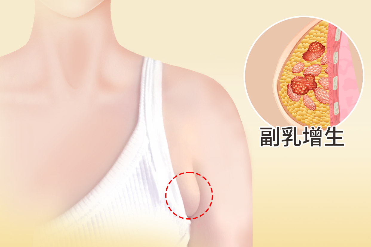 副乳增生图片 乳腺增生 副乳