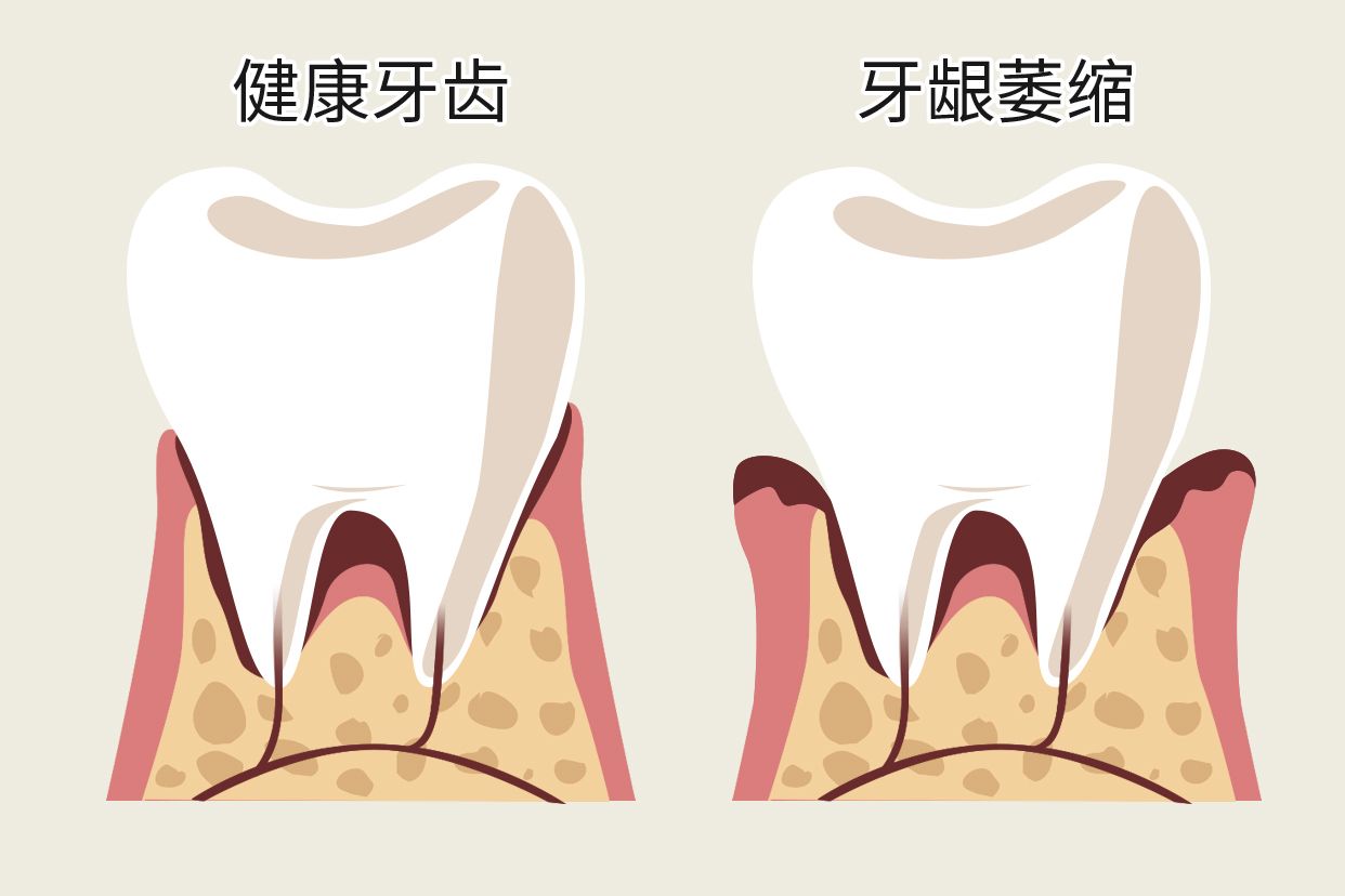 单个牙龈萎缩图片 单个牙龈萎缩图片