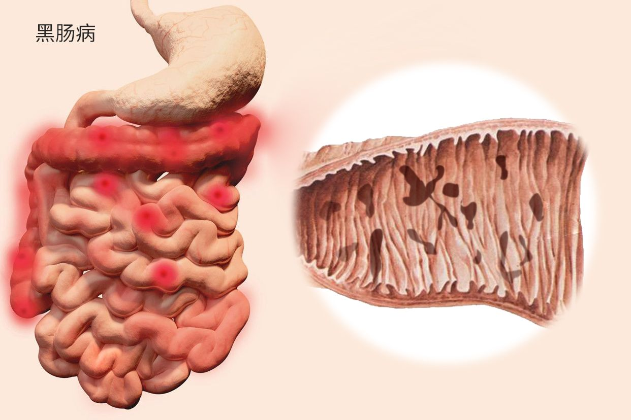 黑肠病图片 黑肠病百科