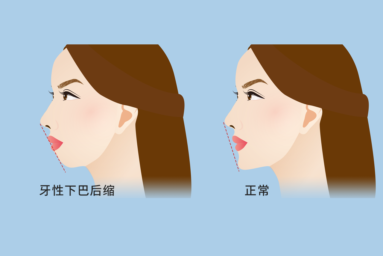 牙性下巴后缩图片 下巴后缩牙齿矫正图