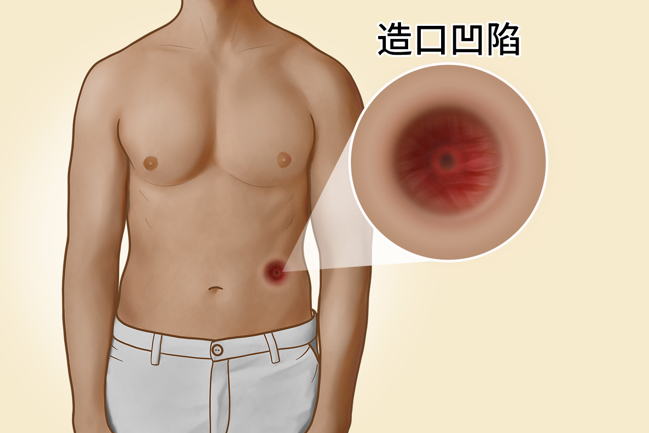 造口缩进去图片 造口会不会缩回去