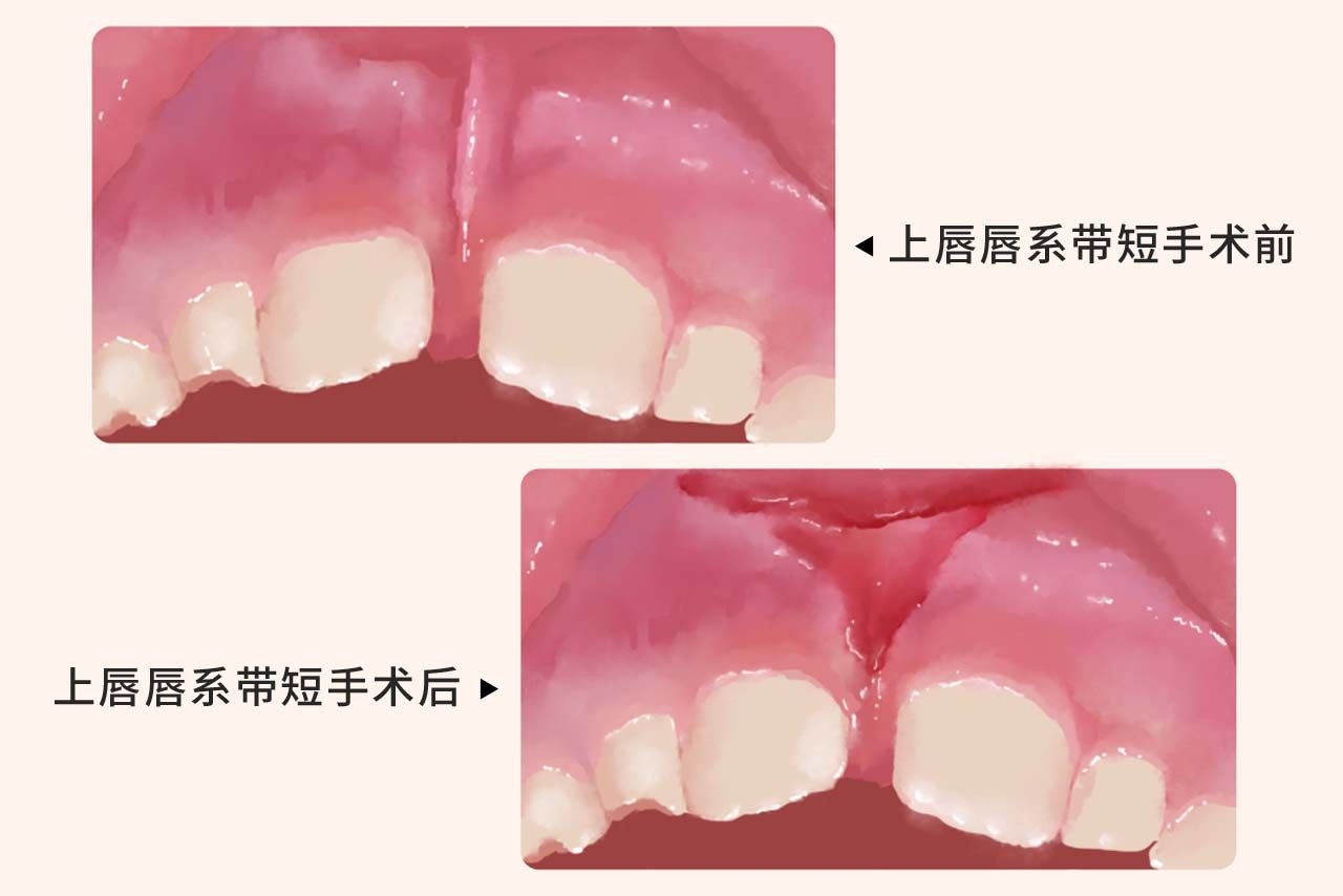 上唇唇系带短手术后图 唇系带低手术前后图片