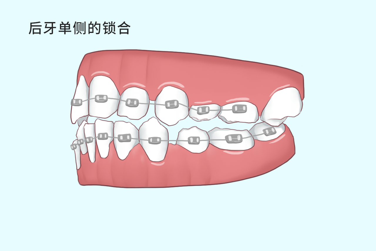 后牙单侧的锁合如何矫正图片（双侧后牙锁合）