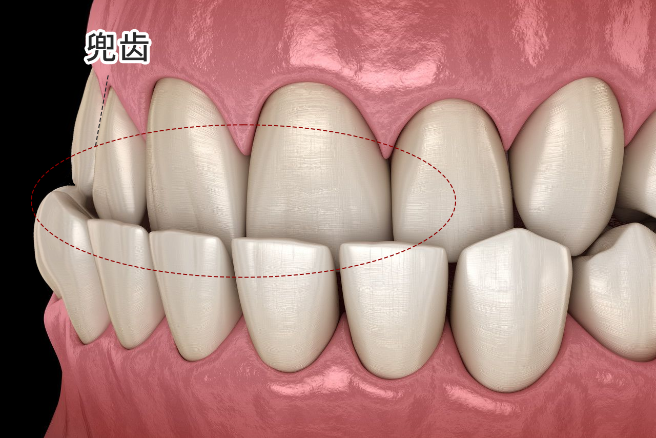 兜齿严重的照片（兜齿什么样子）