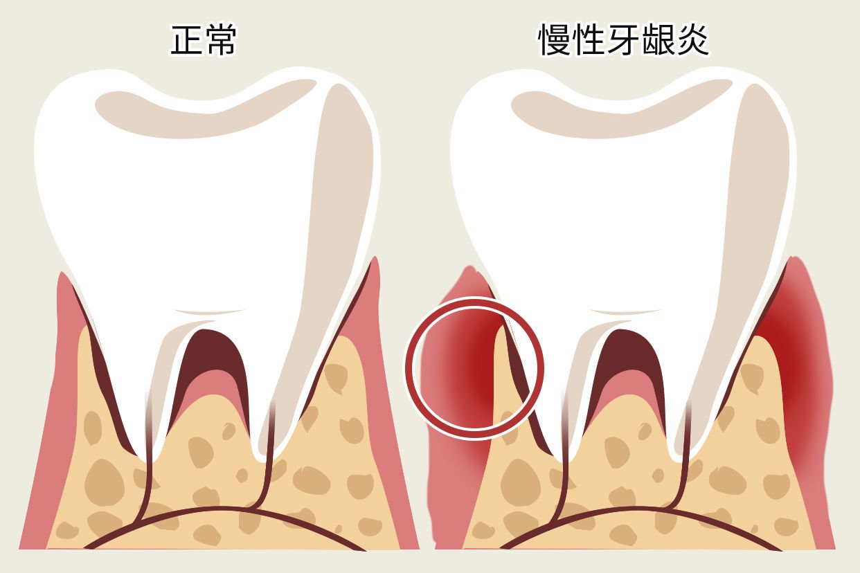 慢性牙龈炎图片 慢性牙龈炎图片及症状