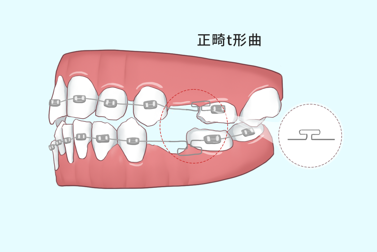 正畸t形曲的作用图解 正畸t型曲的作用图解