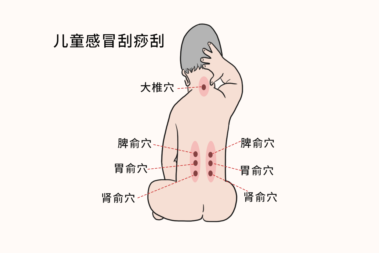 儿童感冒刮痧刮哪里图解 儿童感冒流鼻涕应刮痧哪个位置图解