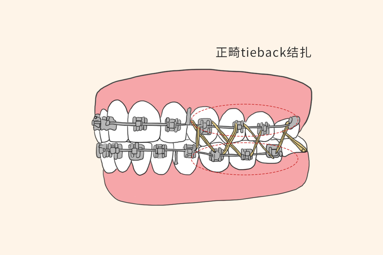 正畸tieback结扎图片 正畸tie back