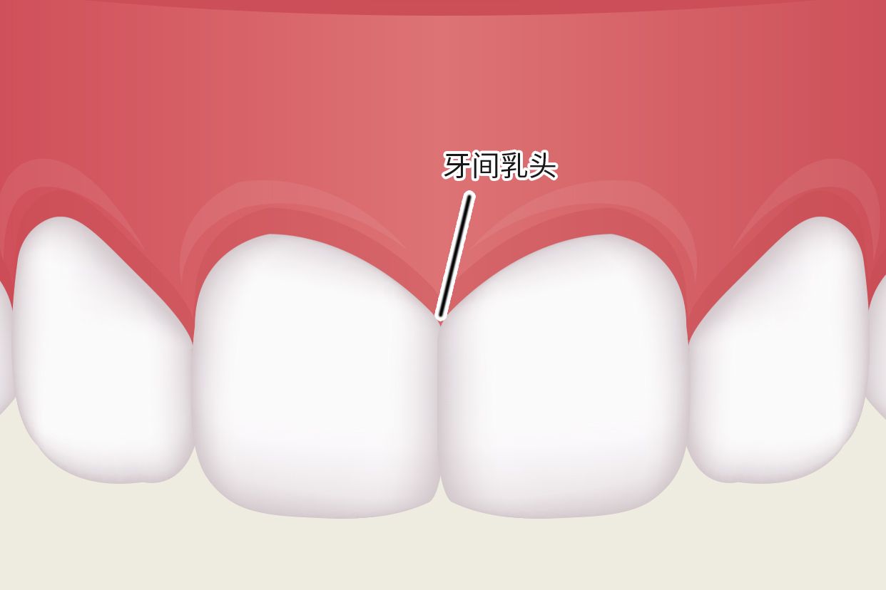 牙龈乳头图片 乳牙 图片