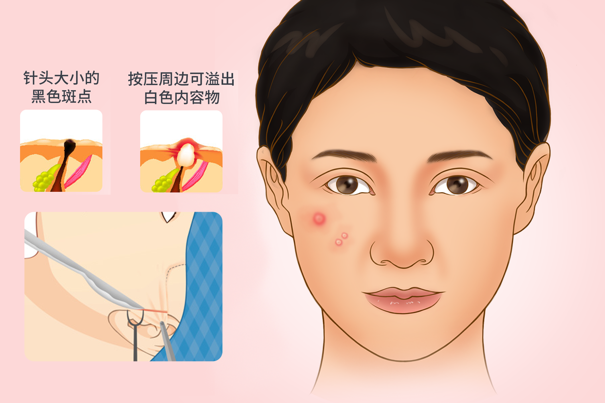 胃食管反流病白痰不断测试-优化