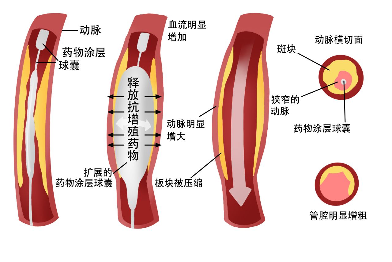 药物球囊和放置过程图