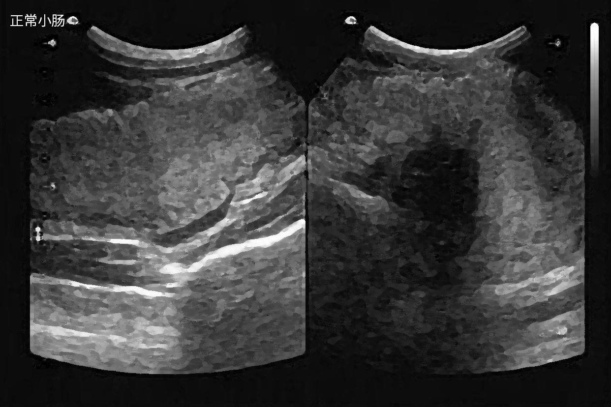 大肠和小肠的超声图像