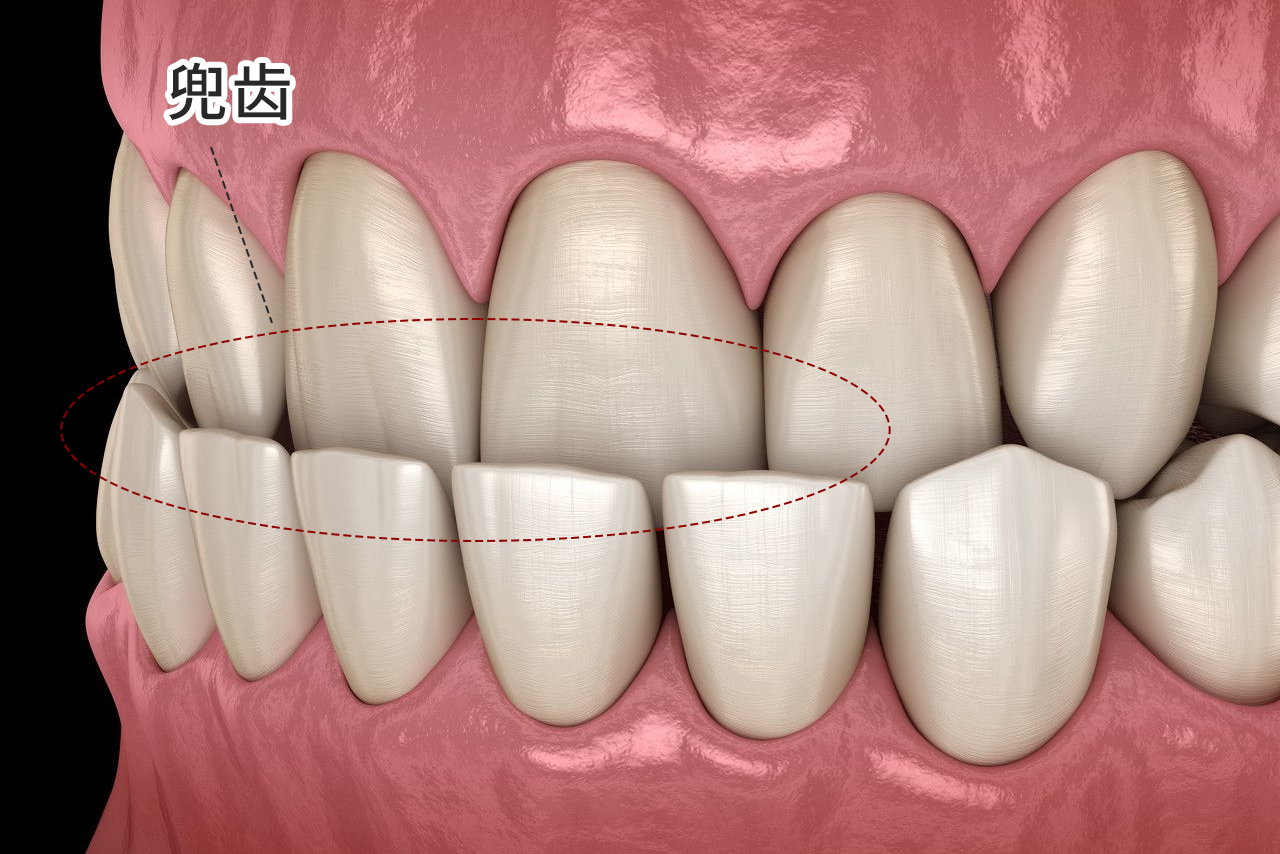 轻微兜齿图片