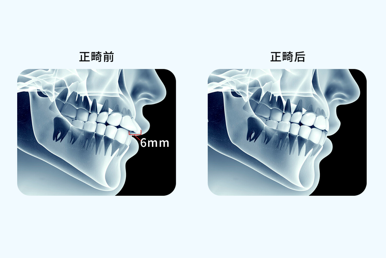 正畸内收6mm效果图