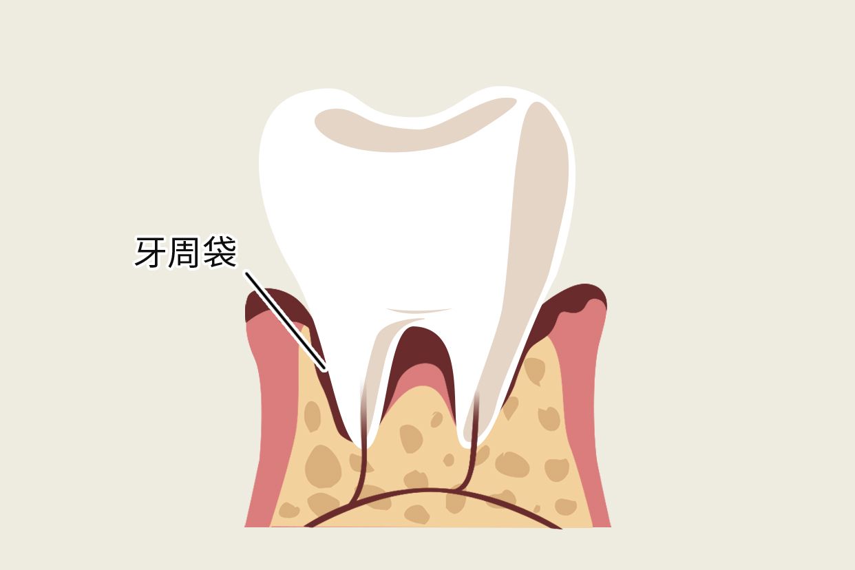 深牙周袋图片