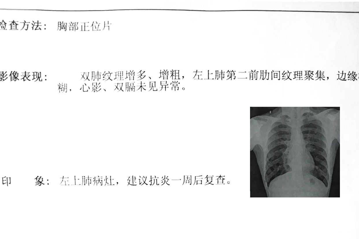 不正常的胸片图和报告 不正常人的胸片图