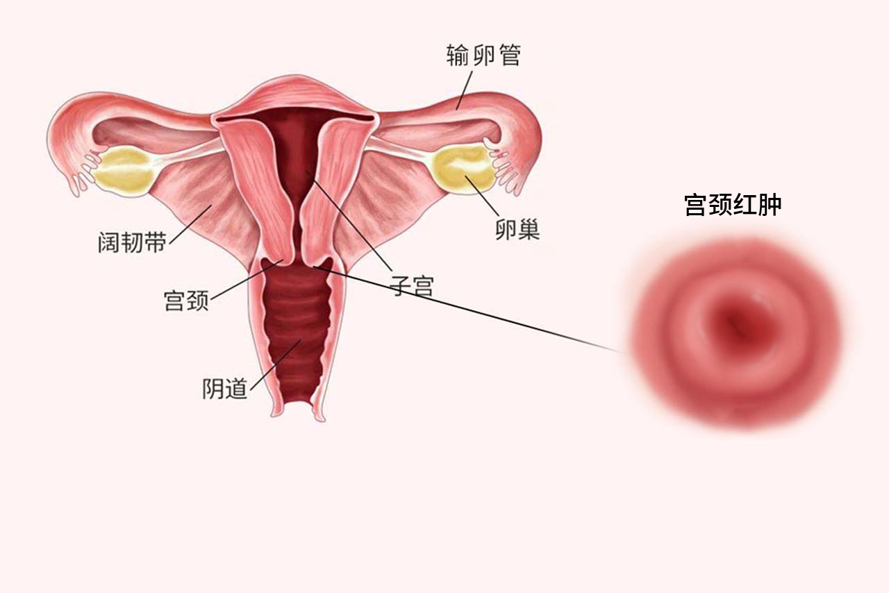 宫颈红肿图片 宫颈红肿要怎么治疗