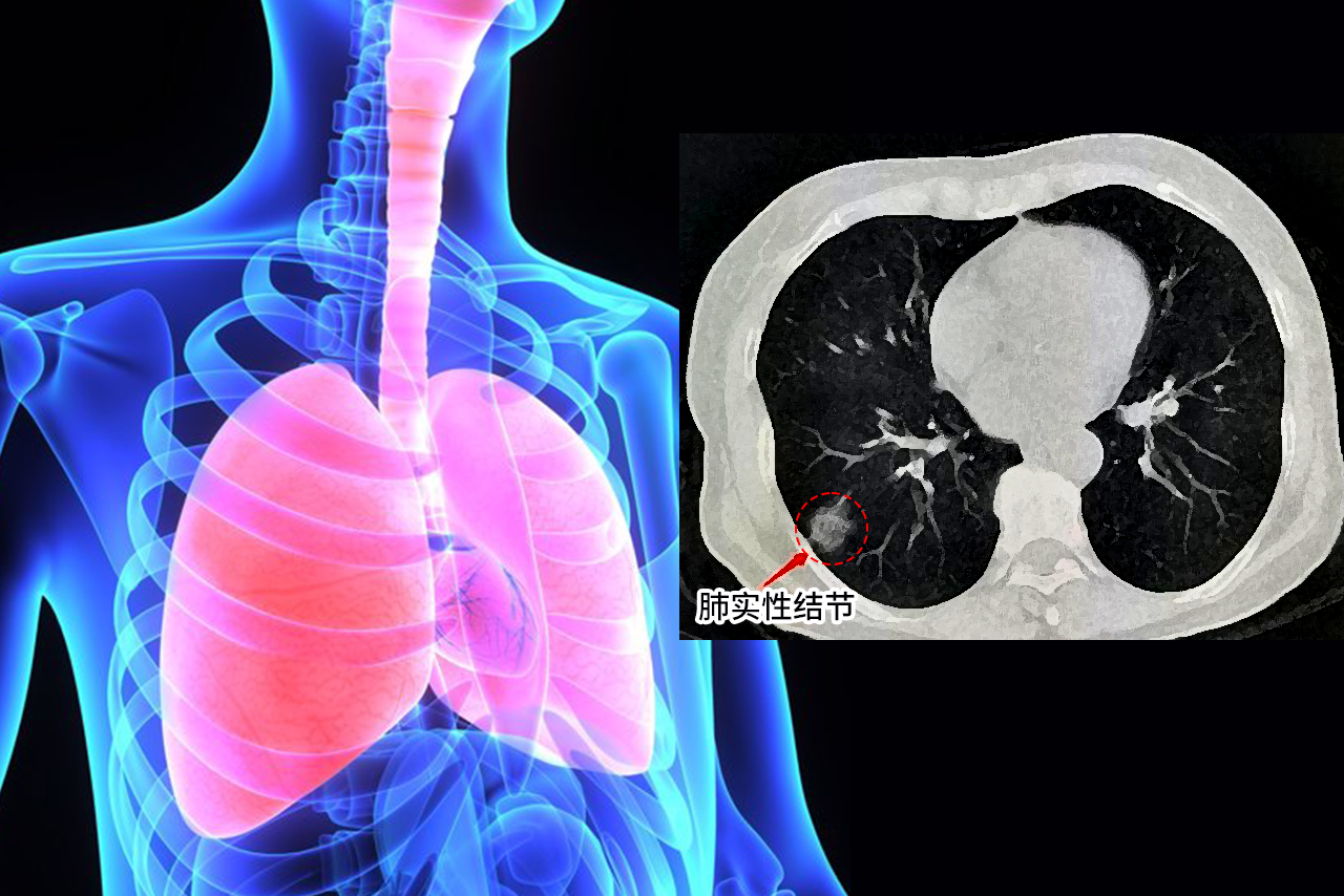 肺实性结节图片 肺实性结节的症状